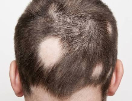 Alopecia Areata